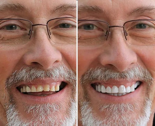 TerraHush™ Snap-On Veneers