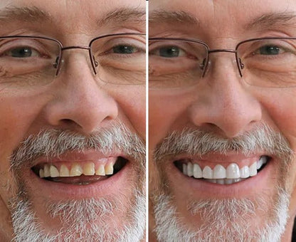 TerraHush™ Snap-On Veneers